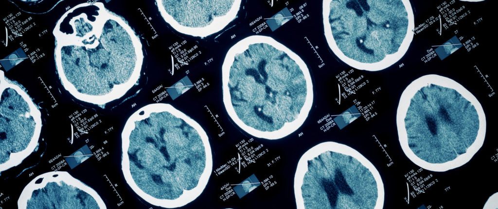 brain scan